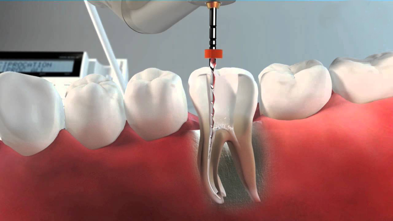 Endodonica mecanizada Endodoncia mecanizada