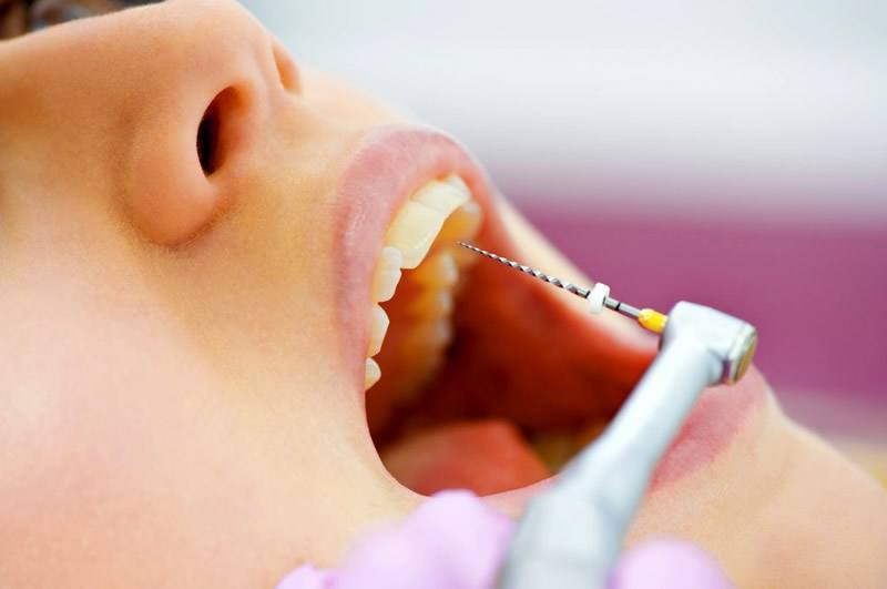 Endodonica mecanizada Endodoncia mecanizada