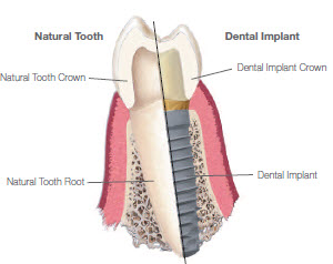 Implantes